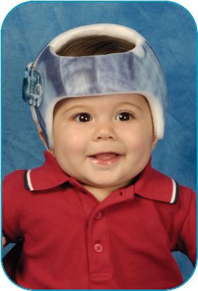 Cranial Remodeling Treatment,Your child has been referred for cranial remodeling treatment and will be fitted with a STARband™ cranial remodeling orthosis.- Image of baby boy wearing helmet